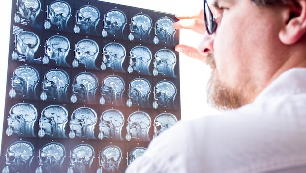 Bessere Diagnosekriterien bei Multipler Sklerose.