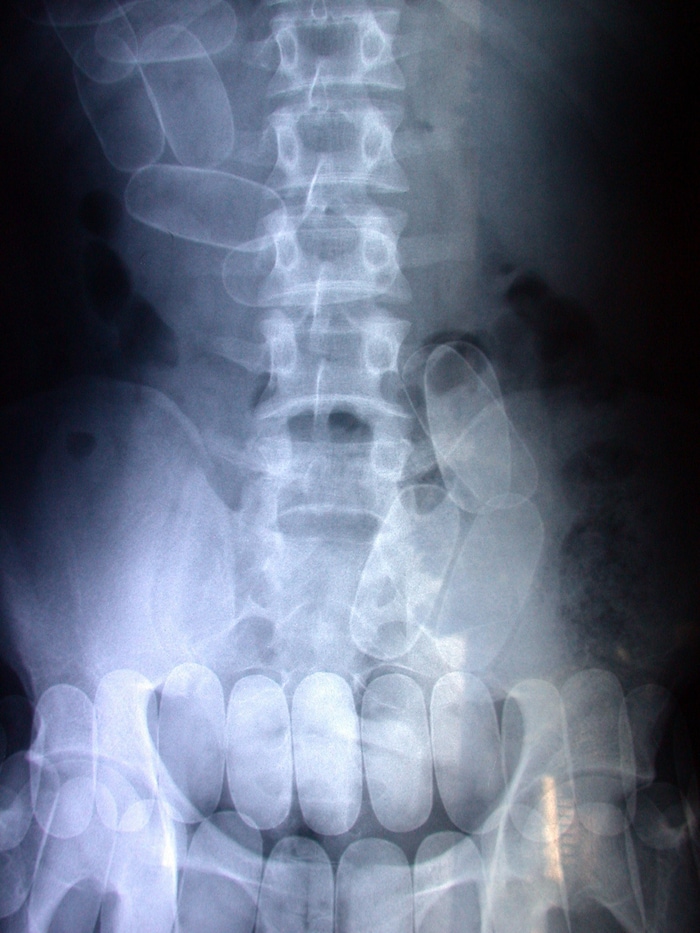 Die Kapseln – hier ein anderer Fall – sind auf dem Bild eines Computertomgrafen zu erkennen.