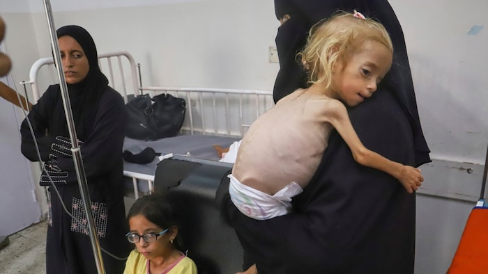 Dieses zweijährige Mädchen in Chan Yunis ist deutlich unterernährt – aber Israel dementiert das ...