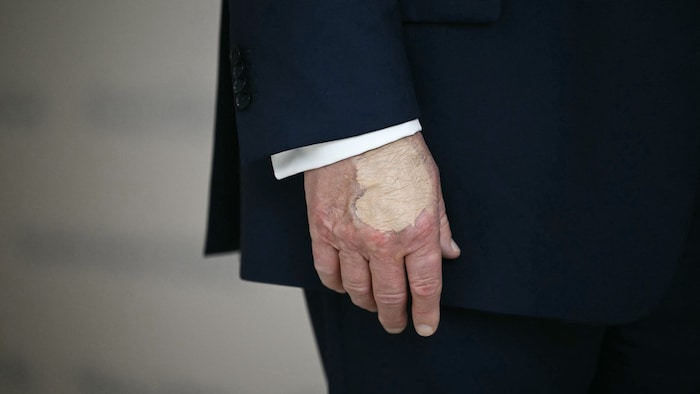 Trumps Bluterguss an der rechten Hand wurde zuletzt mit massivem Einsatz von Make-up verdeckt.