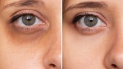 Dunkle Schatten um die Augen lassen einem müde und krank aussehen.