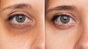 Dunkle Schatten um die Augen lassen einem müde und krank aussehen.