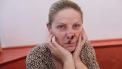 Snezana T. (50) leidet drei Jahre danach noch immer unter den Folgen einer verpfuschten OP – und ...