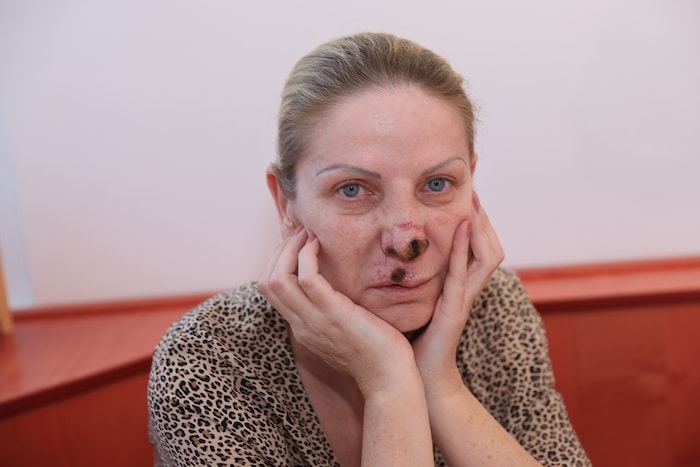 Snezana T. (50) leidet drei Jahre danach noch immer unter den Folgen einer verpfuschten OP – und ...