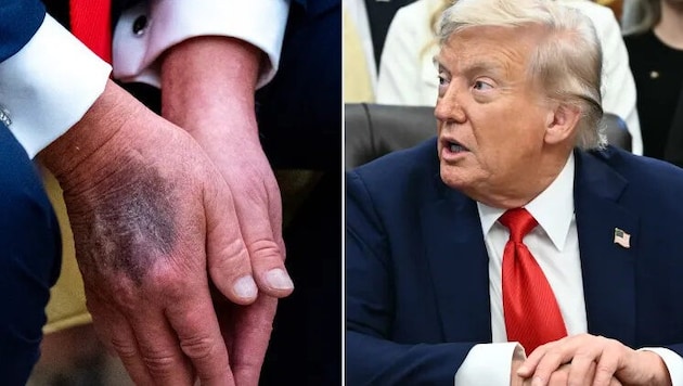 Zu fester Händedruck oder steckt mehr dahinter? Rund um den Gesundheitszustand von US-Präsident ...