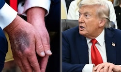 Zu fester Händedruck oder steckt mehr dahinter? Rund um den Gesundheitszustand von US-Präsident ...