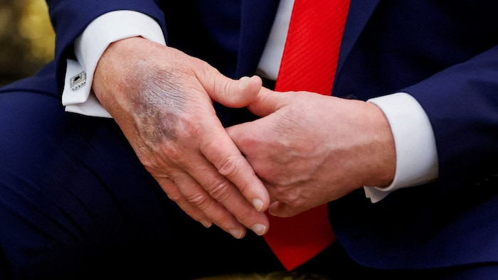 Die blauen Flecken heizen die Spekulationen über den Gesundheitszustand von Donald Trump an.