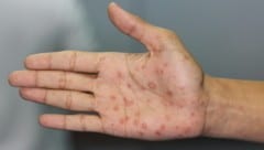 Syphilis ist eine bakterielle verursachte Erkrankung, die nur beim Menschen vorkommt. Sie kann ...