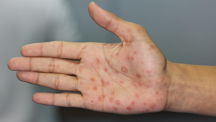 Syphilis ist eine bakterielle verursachte Erkrankung, die nur beim Menschen vorkommt. Sie kann ...