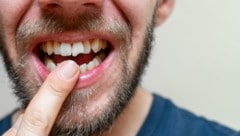 Ein ausgeschlagener Zahn ist in jedem Alter eine unangenehme Erfahrung. (Symbolbild) 