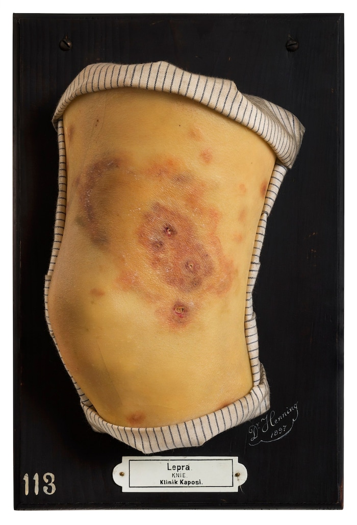Knie mit Lepra, Tuberkuloide (paucibazilliäre) Lepra