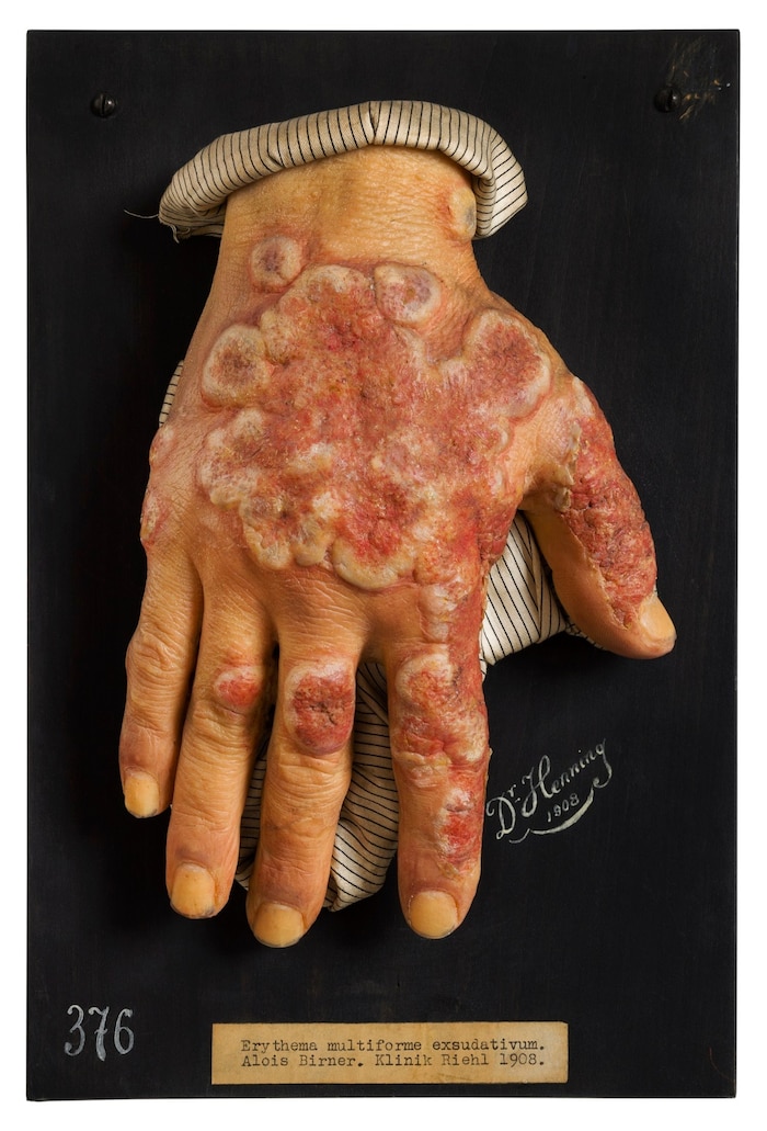 In Wachs verewigt: Rötungen und Entzündungen der Haut, Erythema multiforme exsudativum