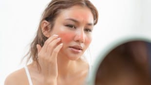 Hinter roten Flecken kann das Hautleiden Couperose stecken.