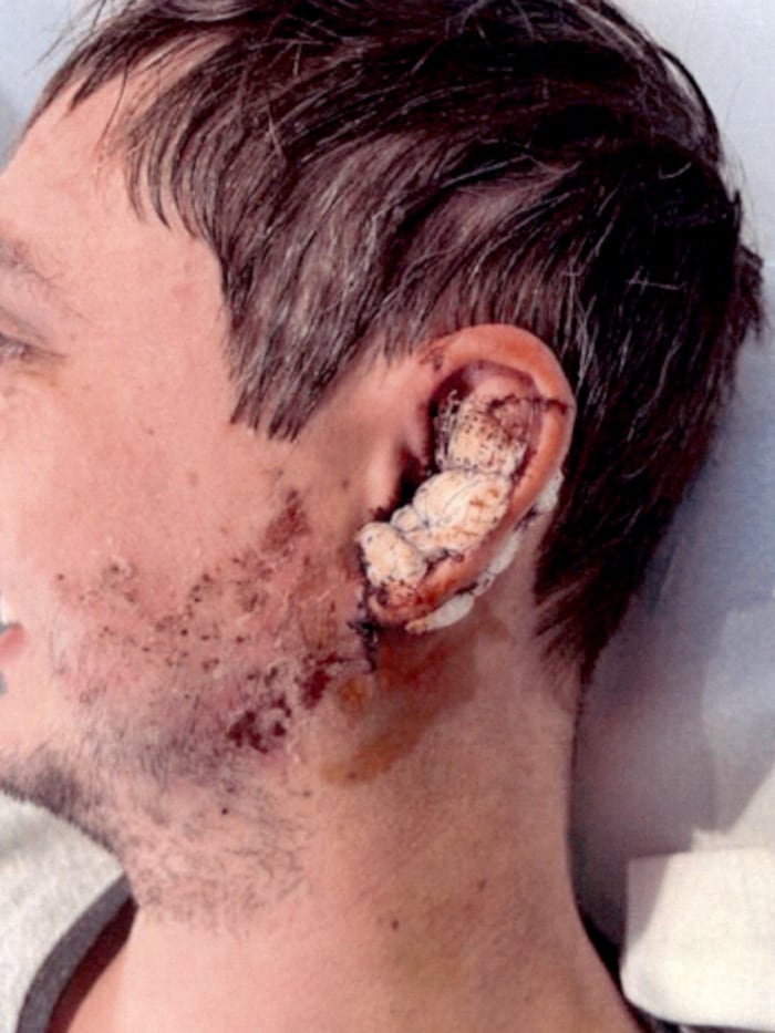 Noch in der Nacht nach dem Unfall wurde der heute 29-Jährige am Ohr operiert. Nach wie vor ...