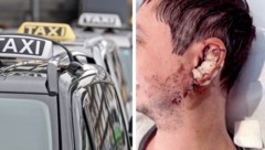 Gleich nach dem Unfall wurde der 28-Jährige in der Innsbrucker Klinik am Ohr operiert.