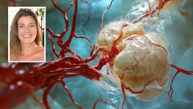 Nadine Klein (o.l.) überlebte ein gerissenes Aneurysma.