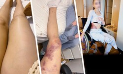 Die 25-jährige Klara O. verlor nach einer bakteriellen Infektion ihren rechten Oberschenkel. ...