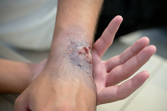 Eine offene Wunde rund um die Verletzung ist ein klares Anzeichen für einen offenen Bruch – in ...