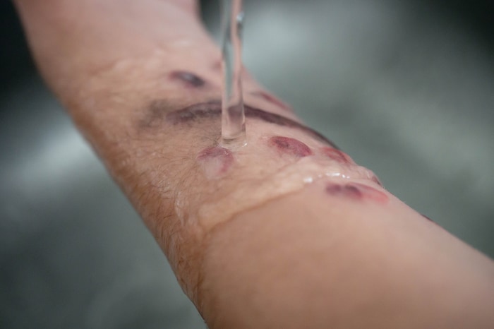 Das Kühlen der Wunde ist zentraler Bestandteil der Ersten Hilfe bei Verbrennungen.