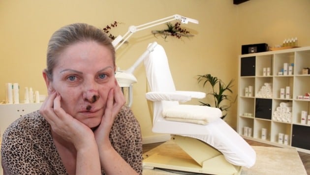 „Nasen-Opfer“ Snezana nach der Behandlung in einer Wiener Schönheitsklinik. Sie leidet heute ...