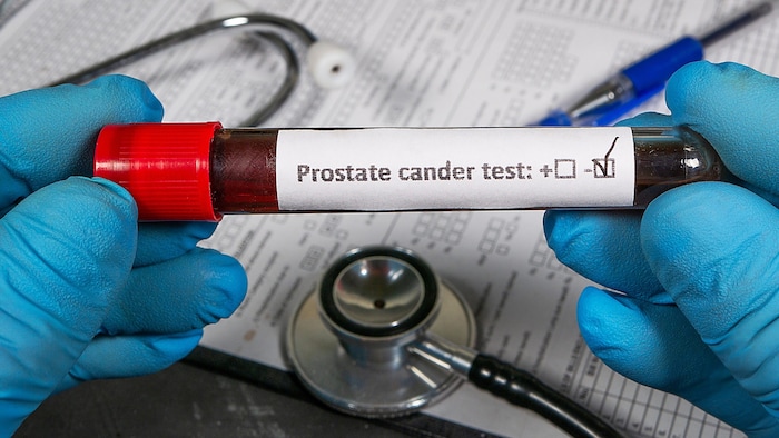 Bei einem PSA-Test wird die Konzentration des prostataspezifischen Antigens im Blut bestimmt, ...