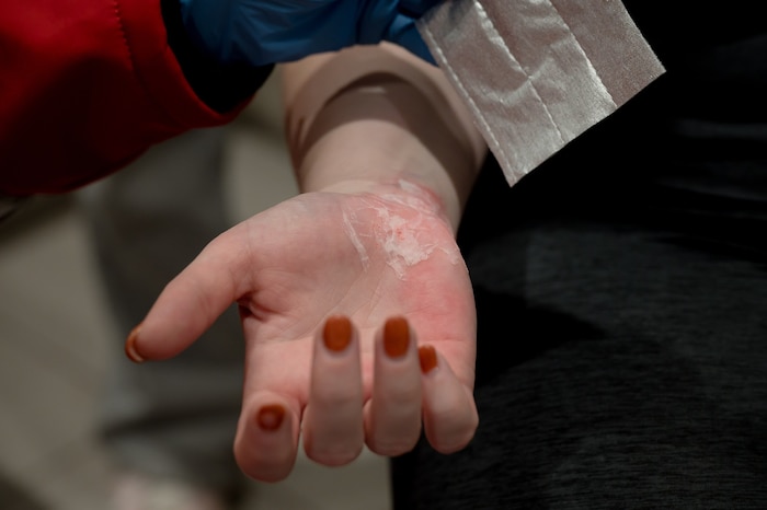 Ersthelfer sollten aus Selbstschutz Einmalhandschuhe verwenden, bevor sie die Wunde steril ...