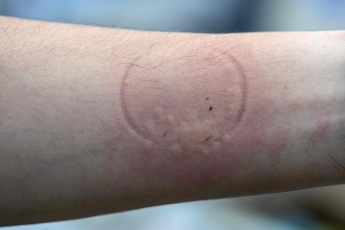 Die Wissenschaftler lassen sich absichtlich von Bettwanzen beißen.