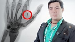 Herr Wang postete das Röntgenbild seiner Hand mit dem Chip im Internet und klagte Freunden und ...