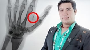 Herr Wang postete das Röntgenbild seiner Hand mit dem Chip im Internet und klagte Freunden und ...