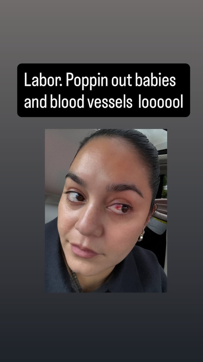 Bei der Entbindung ist Hudgens ein Blutgefäß im Auge geplatzt.