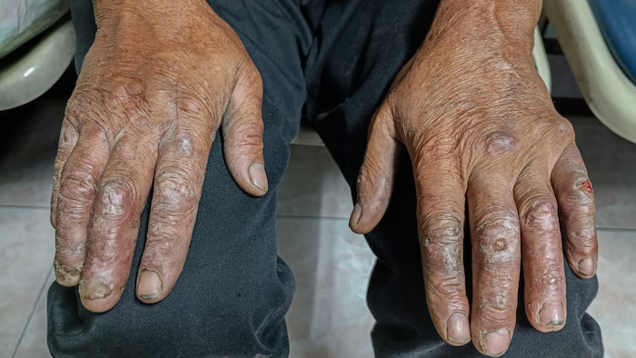 Hautveränderungen durch eine Lepra-Infektion (Symbolbild)