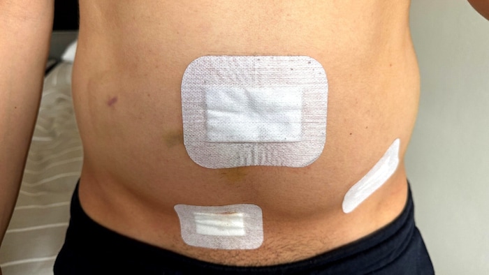 Bereits am Tag nach der OP verspürte der Patient erneut starke Schmerzen ...