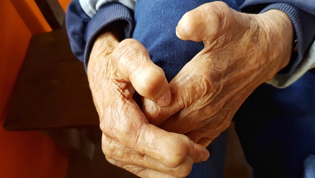 Unbehandelt kann die Krankheit zu Deformationen von Gliedmaßen führen.