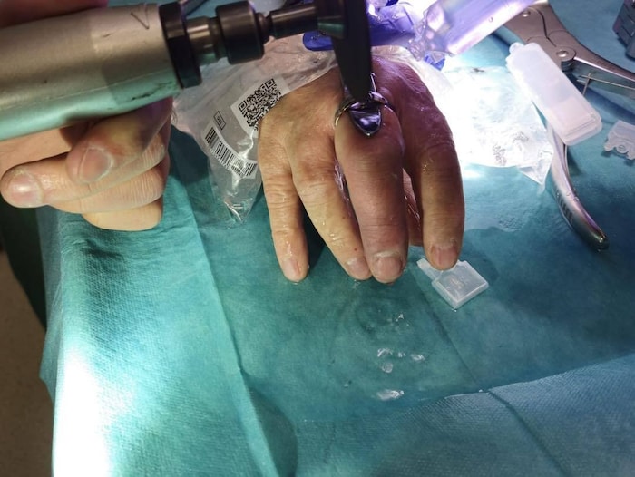 Der Finger war schon sehr geschwollen.