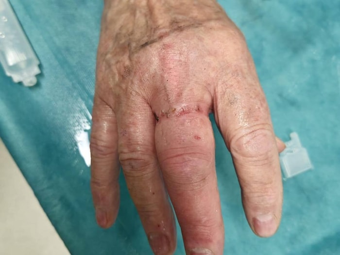 Erleichterung: Der Ring ist ab.