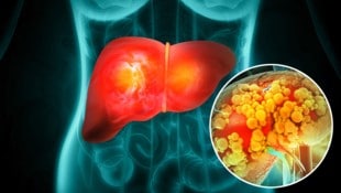 Studien zeigen: Wer zuckerhaltige Getränke meidet und Fruktose reduziert, kann den Fettgehalt ...