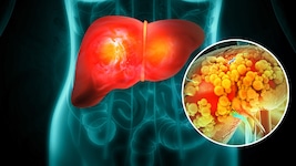 Studien zeigen: Wer zuckerhaltige Getränke meidet und Fruktose reduziert, kann den Fettgehalt ...
