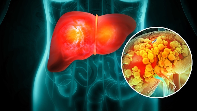 Studien zeigen: Wer zuckerhaltige Getränke meidet und Fruktose reduziert, kann den Fettgehalt ...