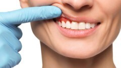 Rot, blutend, entzündet: Das Zahnfleisch leidet.