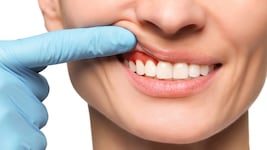 Rot, blutend, entzündet: Das Zahnfleisch leidet.