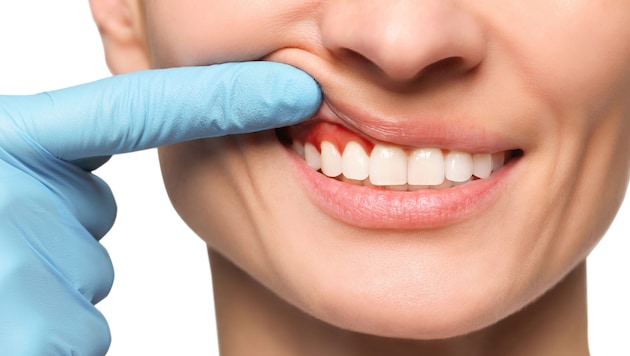 Rot, blutend, entzündet: Das Zahnfleisch leidet.