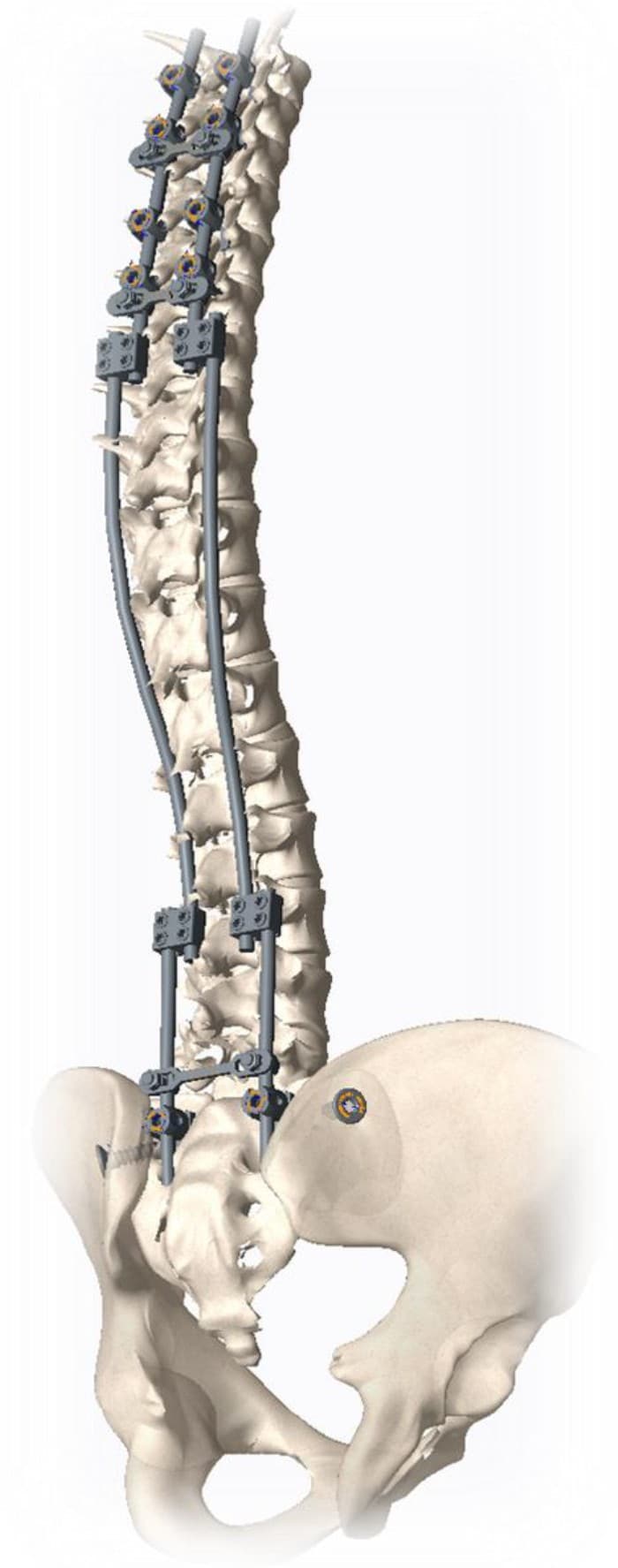 Verankerung zur Korrektur der Verkrümmung bei der „bipolaren Instrumentierung“