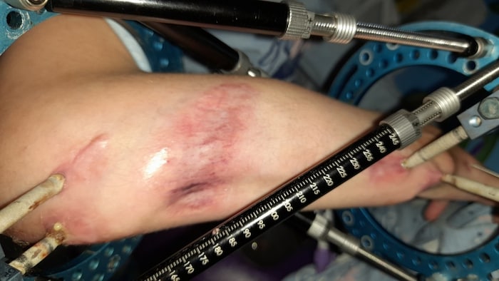 My Duyen trägt derzeit einen Fixateur an der rechten Hand. Er soll helfen, ihre Hand zu strecken ...