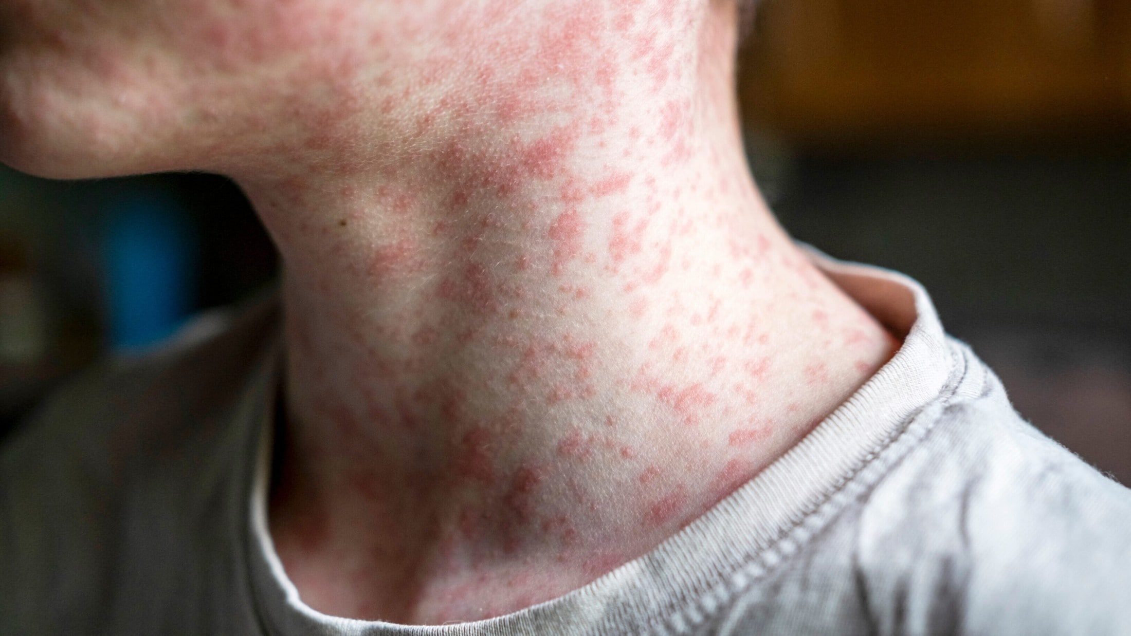 Measles outbreak in Pennsylvania claims first US deaths in 35 years