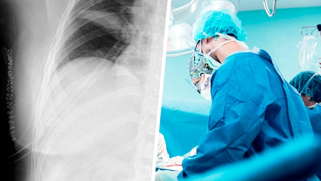 The doctors advised the woman to have surgery quickly – the X-ray shows the 21 staples after the ...