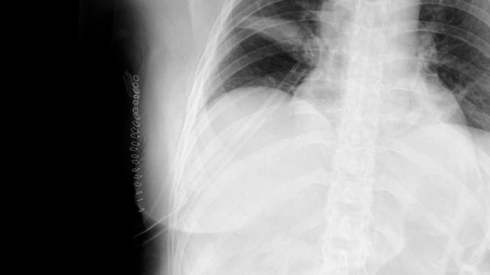 The doctors advised the woman to have surgery quickly—the X-ray shows the 21 staples after the ...
