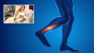 Eine der schwersten Komplikationen nach einem Beinbruch ist das Kompartment-Syndrom.