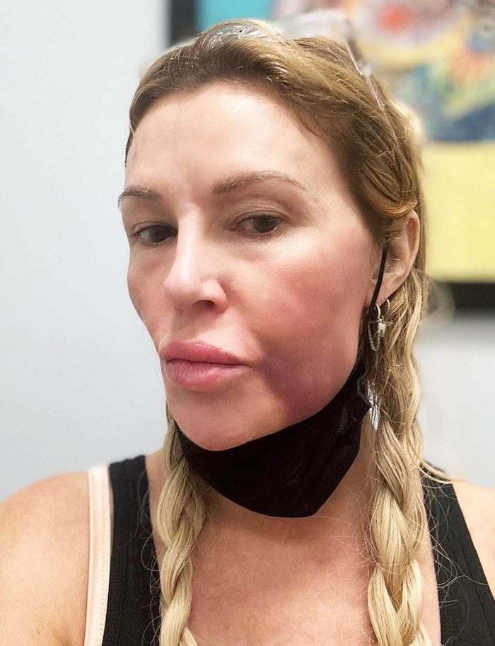 2024 zeigte Glanville auf Instagram, was mit ihrem Gesicht passiert ist.