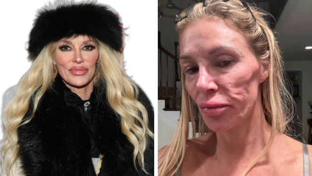 Brandi Glanville (links im Jänner 2026) hat endlich die richtige Diagnose bekommen: Als 2024 ...