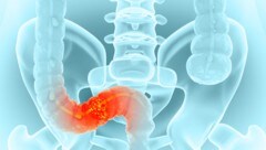 Darmgewächse früh entfernen, damit kein Krebs entsteht.